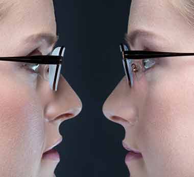 Differenza di spessore tra lenti comuni e ad alto indice