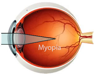 myopia